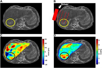 Magnetic resonance elastography of malignant tumors